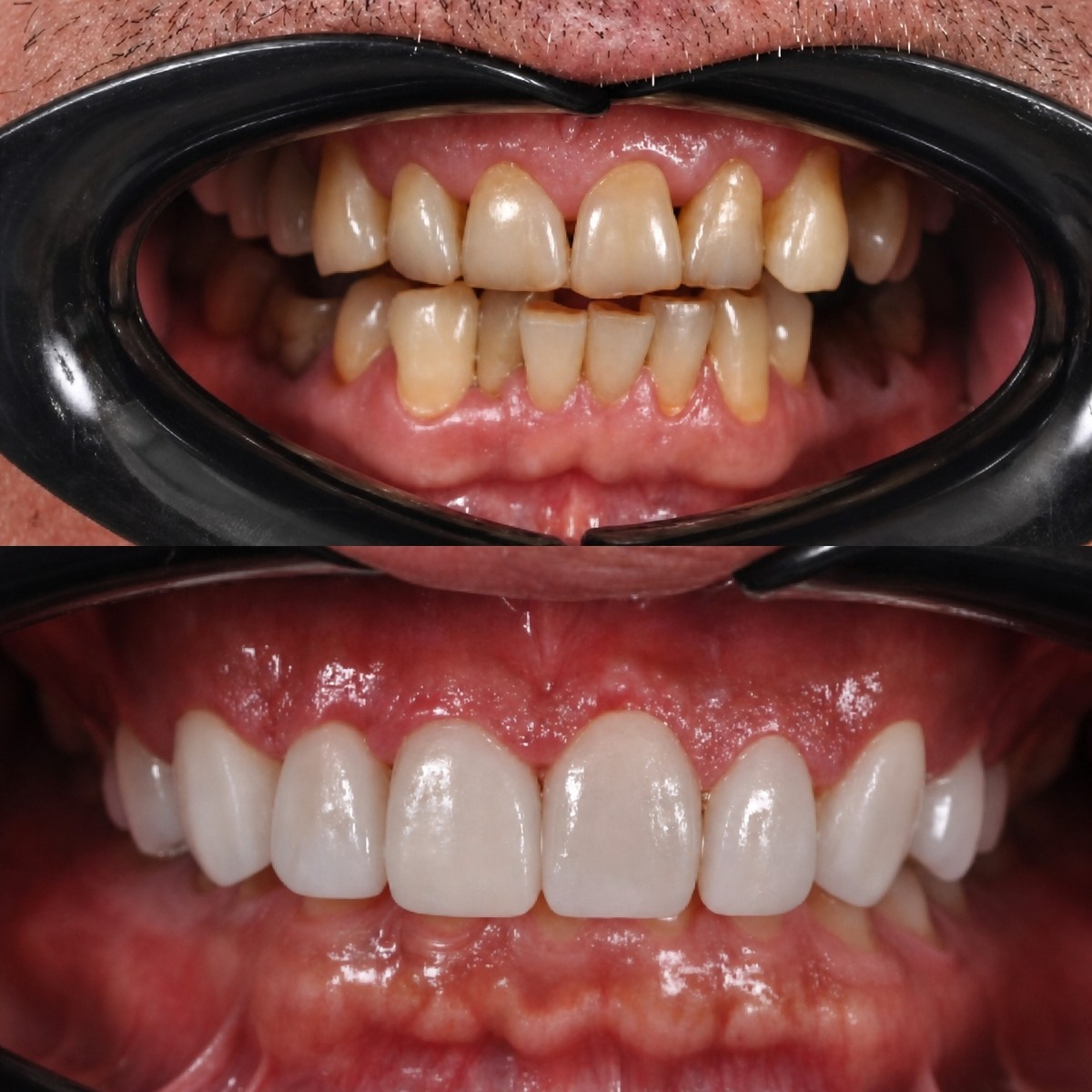 Résultats avant et après facettes dentaires à Kitcha Dental Clinic, transformation du sourire