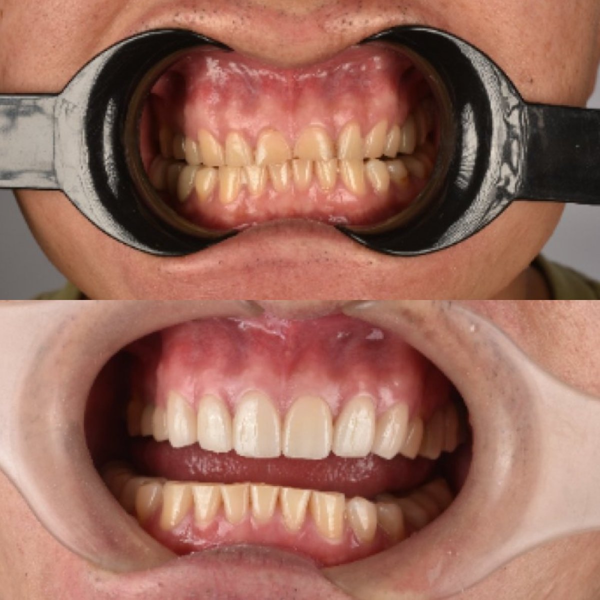 نتائج قبل وبعد قشور البورسلين في Kitcha Dental Clinic، تحسين جمالية الابتسامة