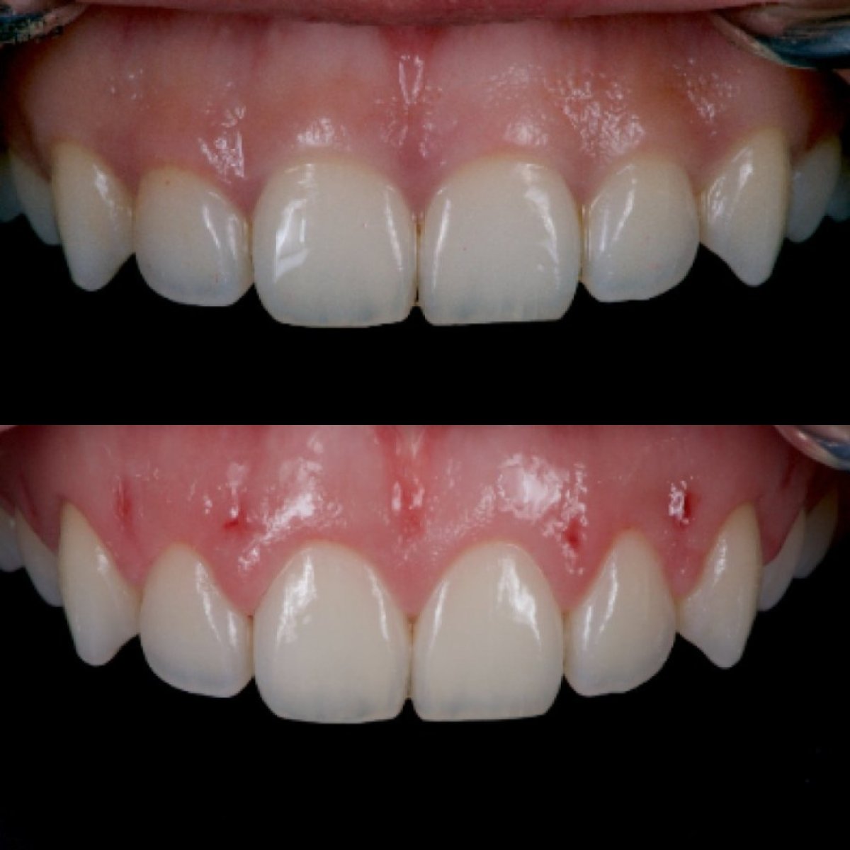 Résultats avant et après gingivectomie à Kitcha Dental Clinic, contour gingival amélioré