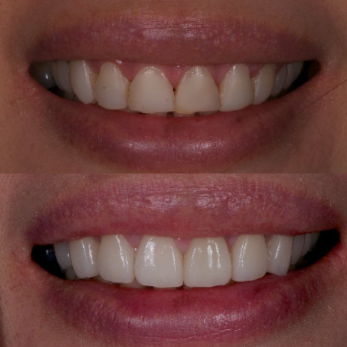 نتائج قبل وبعد قشور البورسلين في عيادة Kitcha Dental Clinic، تحسين مظهر الابتسامة
