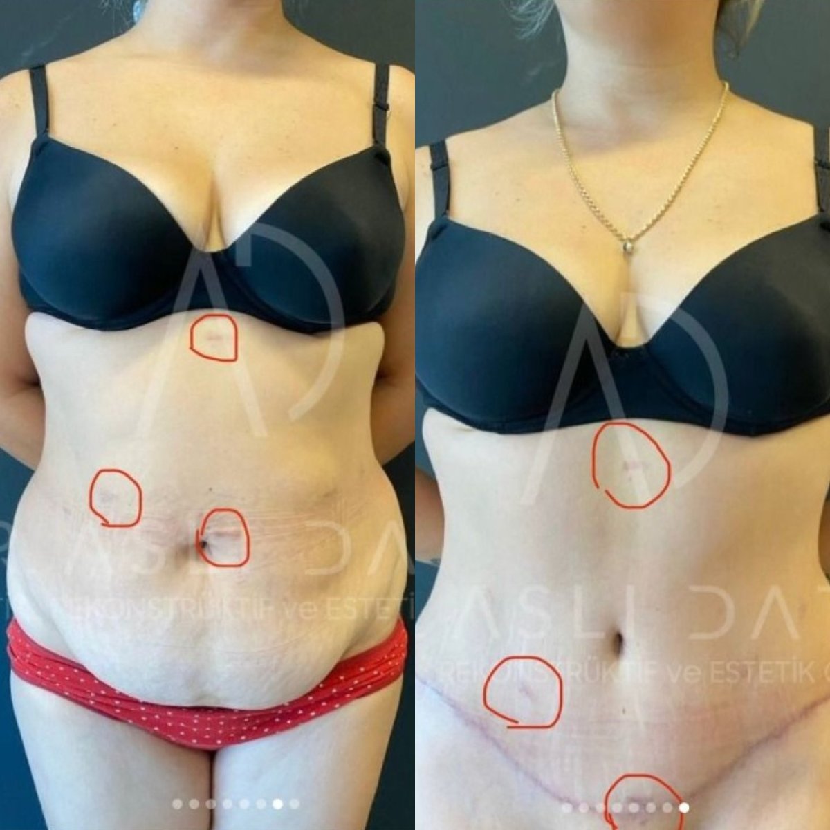 Antes y después de liposucción en Liv Hospital Ulus, resultados visibles en el abdomen