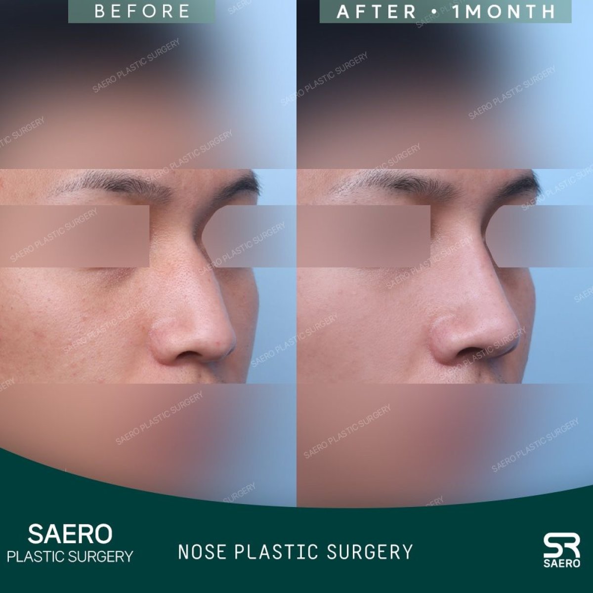 Résultats avant et après rhinoplastie ouverte chez SAERO Plastic Surgery, remodelage du nez