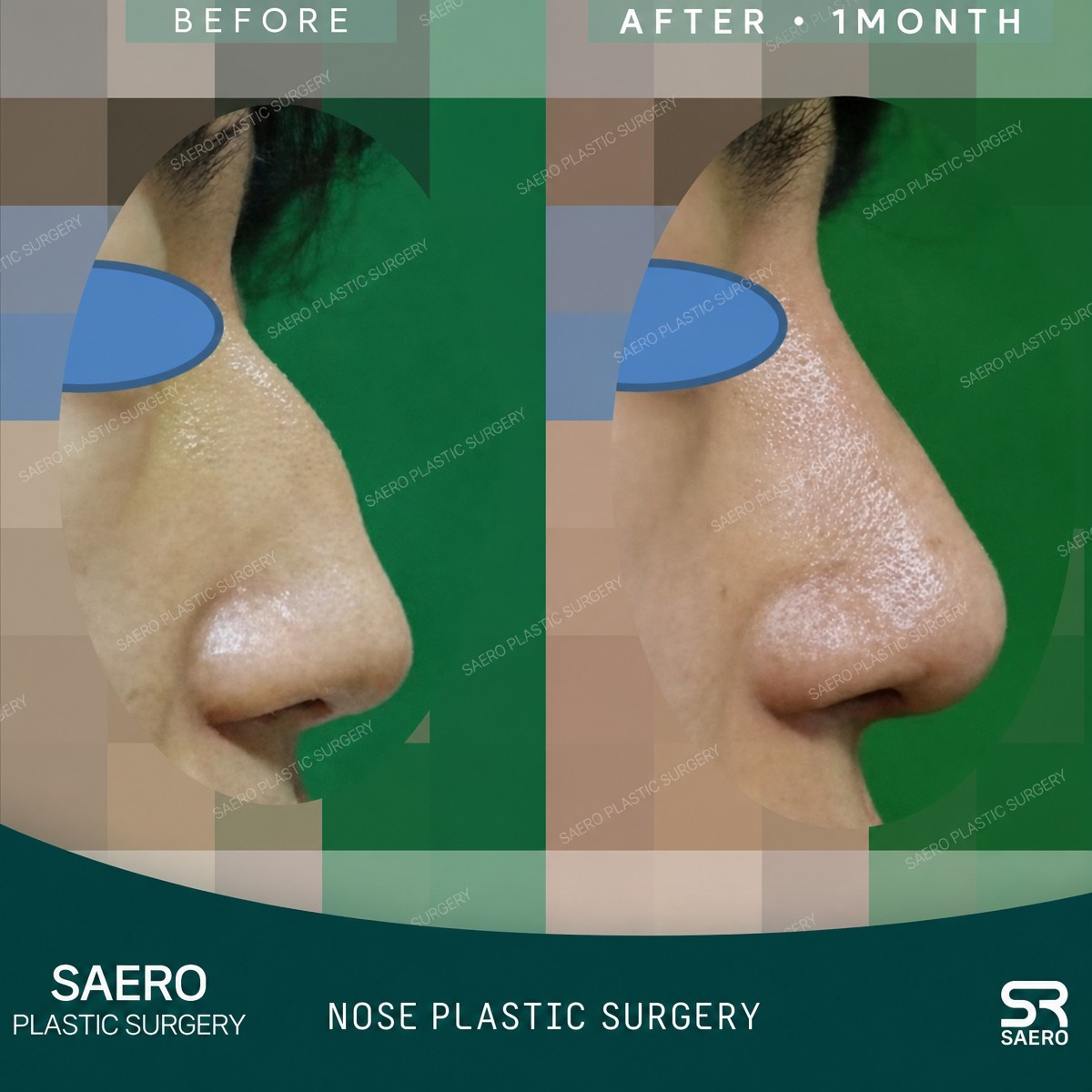 Before and after open rhinoplasty results at SAERO Plastic Surgery, improved nose profile