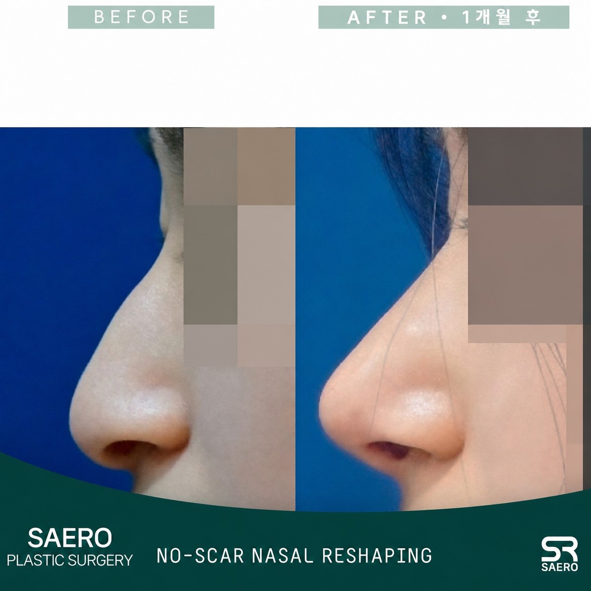 نتائج قبل وبعد عملية تجميل الأنف المفتوحة في SAERO Plastic Surgery، إعادة تشكيل طبيعية للأنف