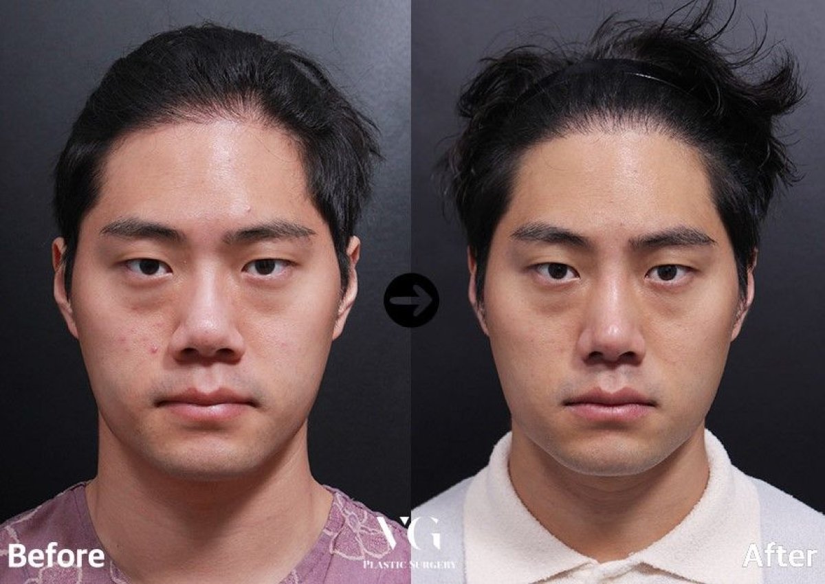 Результат до і після відкритої ринопластики у VG Plastic Surgery, покращення форми носа