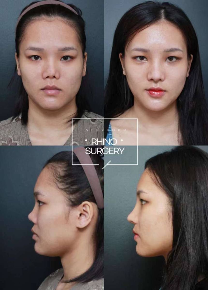 Résultats avant et après rhinoplastie ouverte chez VG Plastic Surgery, amélioration du nez