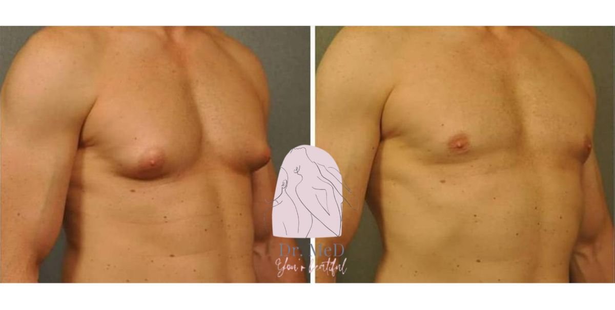 نتائج قبل وبعد جراحة التثدي في Dr. MED – تحسين شكل صدر الرجل