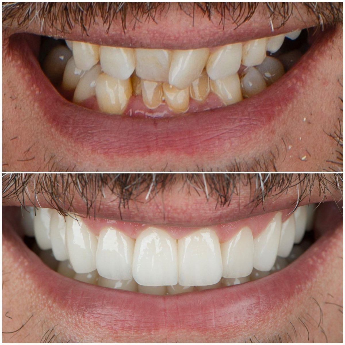 Before and after veneers at ÜMRAN TIP MERKEZİ, smile transformation and whiter teeth result