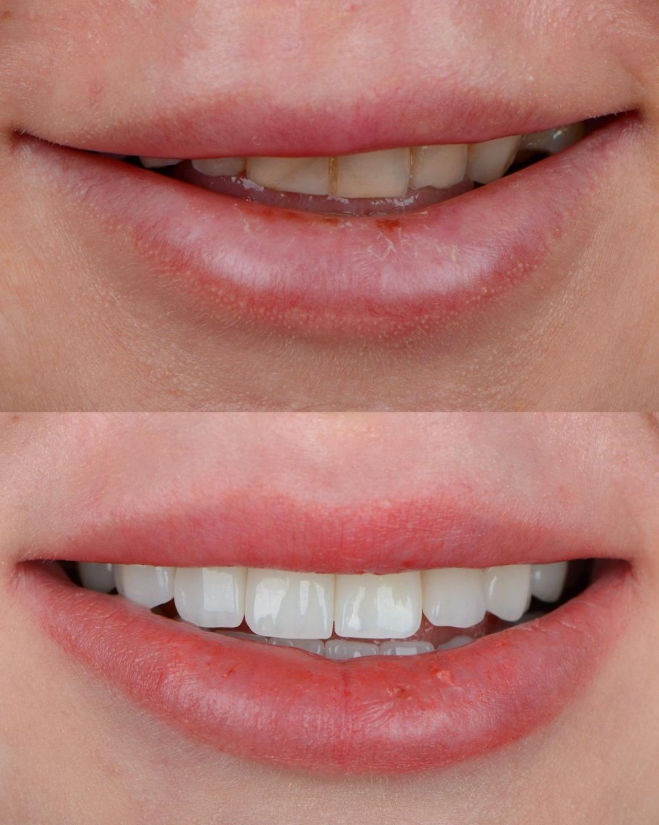 Antes y después de carillas dentales en ÜMRAN TIP MERKEZİ, sonrisa natural