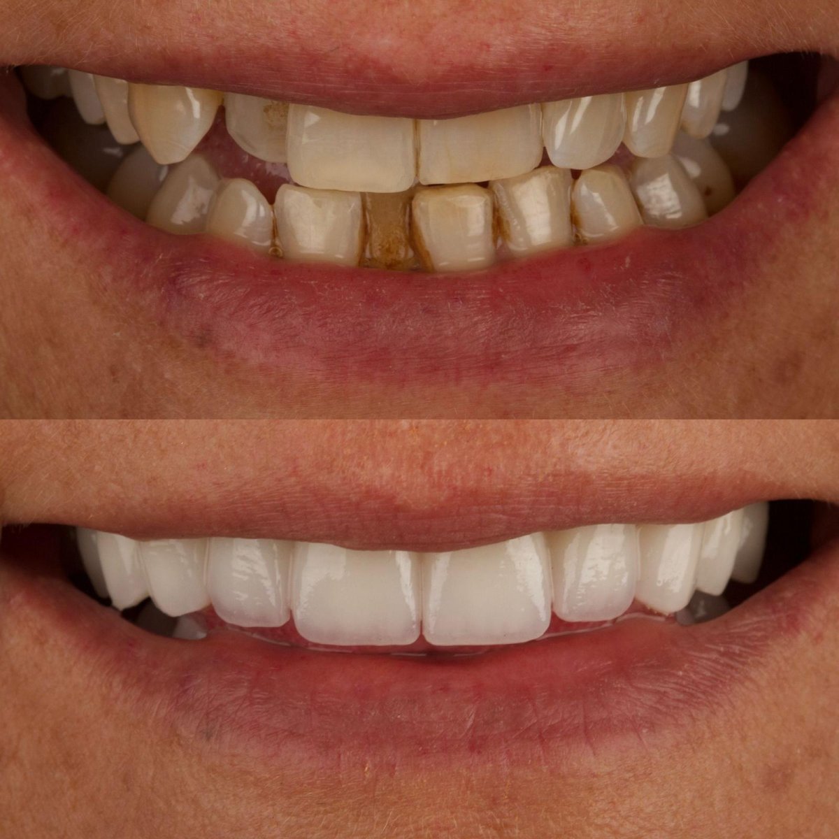 Before and after veneers at ÜMRAN TIP MERKEZİ – smile makeover with natural white teeth result