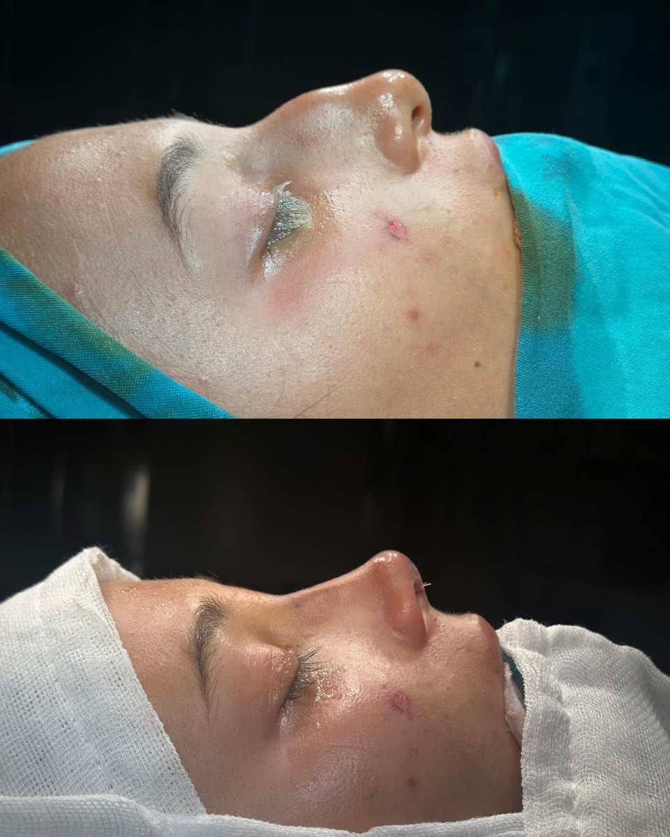 Resultados de rinoplastia antes y después en ÜMRAN TIP MERKEZİ, perfil nasal mejorado