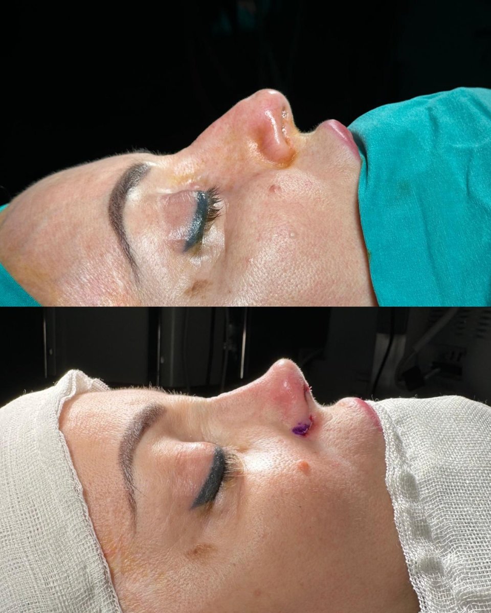 Resultados de rinoplastia antes y después en ÜMRAN TIP MERKEZİ, mejora de la forma nasal