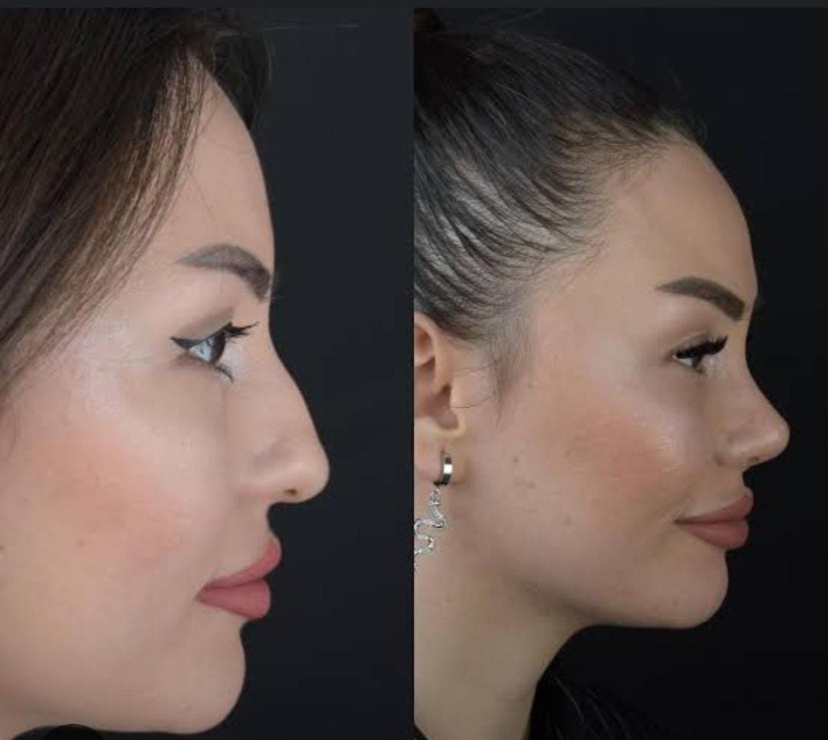 Before and after rhinoplasty results at ÜMRAN TIP MERKEZİ, improved nose profile
