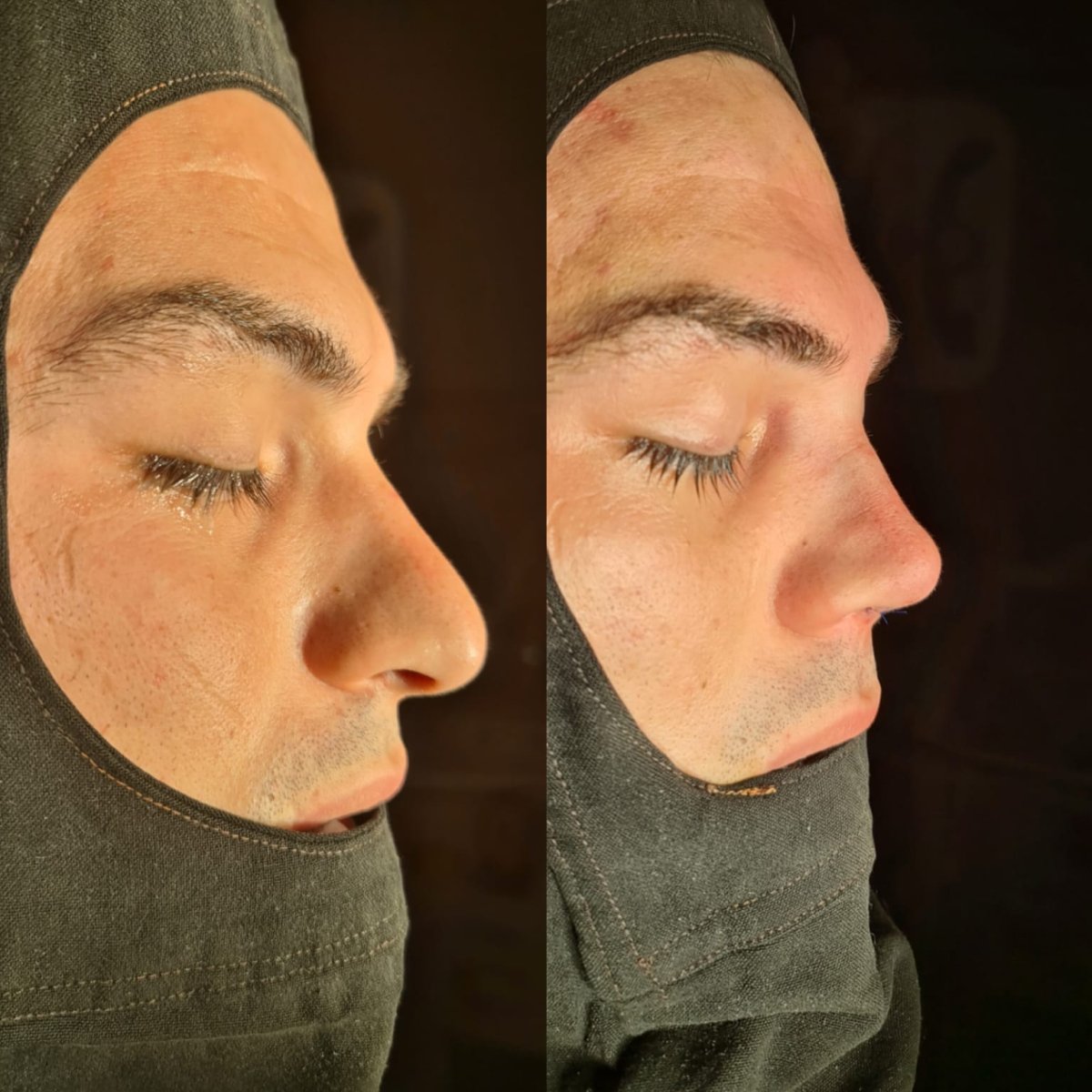 Resultados de rinoplastia antes y después en ÜMRAN TIP MERKEZİ, perfil nasal mejorado