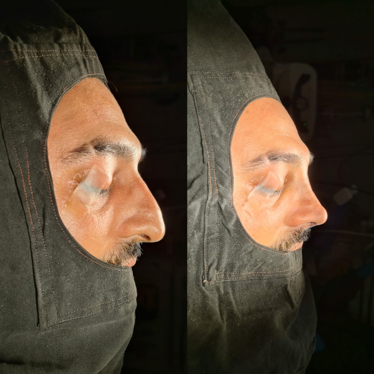 Resultados de rinoplastia antes y después en ÜMRAN TIP MERKEZİ, mejora de la nariz masculina