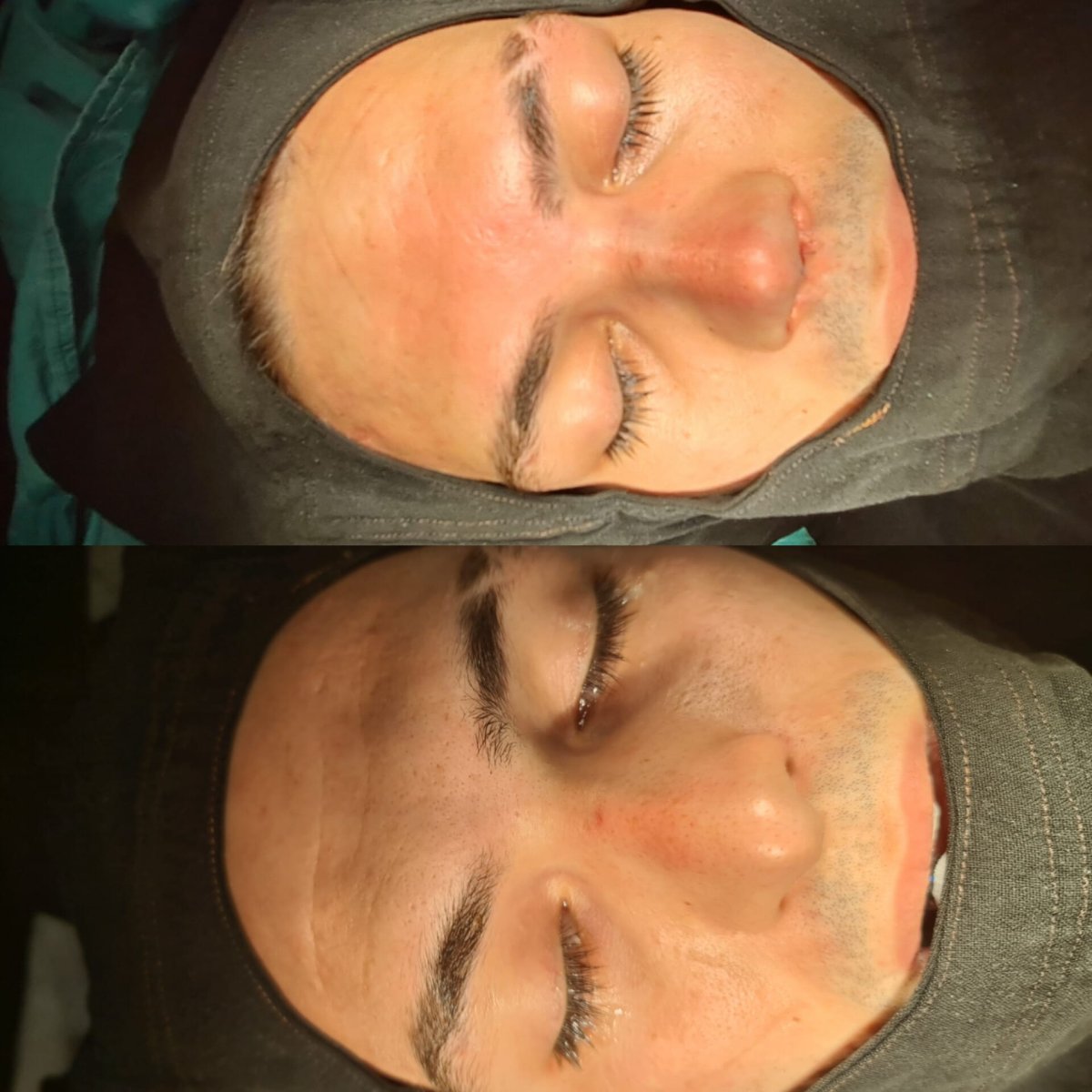 Resultados de rinoplastia antes y después en ÜMRAN TIP MERKEZİ, mejor forma y simetría nasal