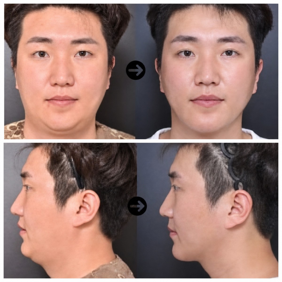 Before and after neck lift results at VG Plastic Surgery, improved jawline and neck contour