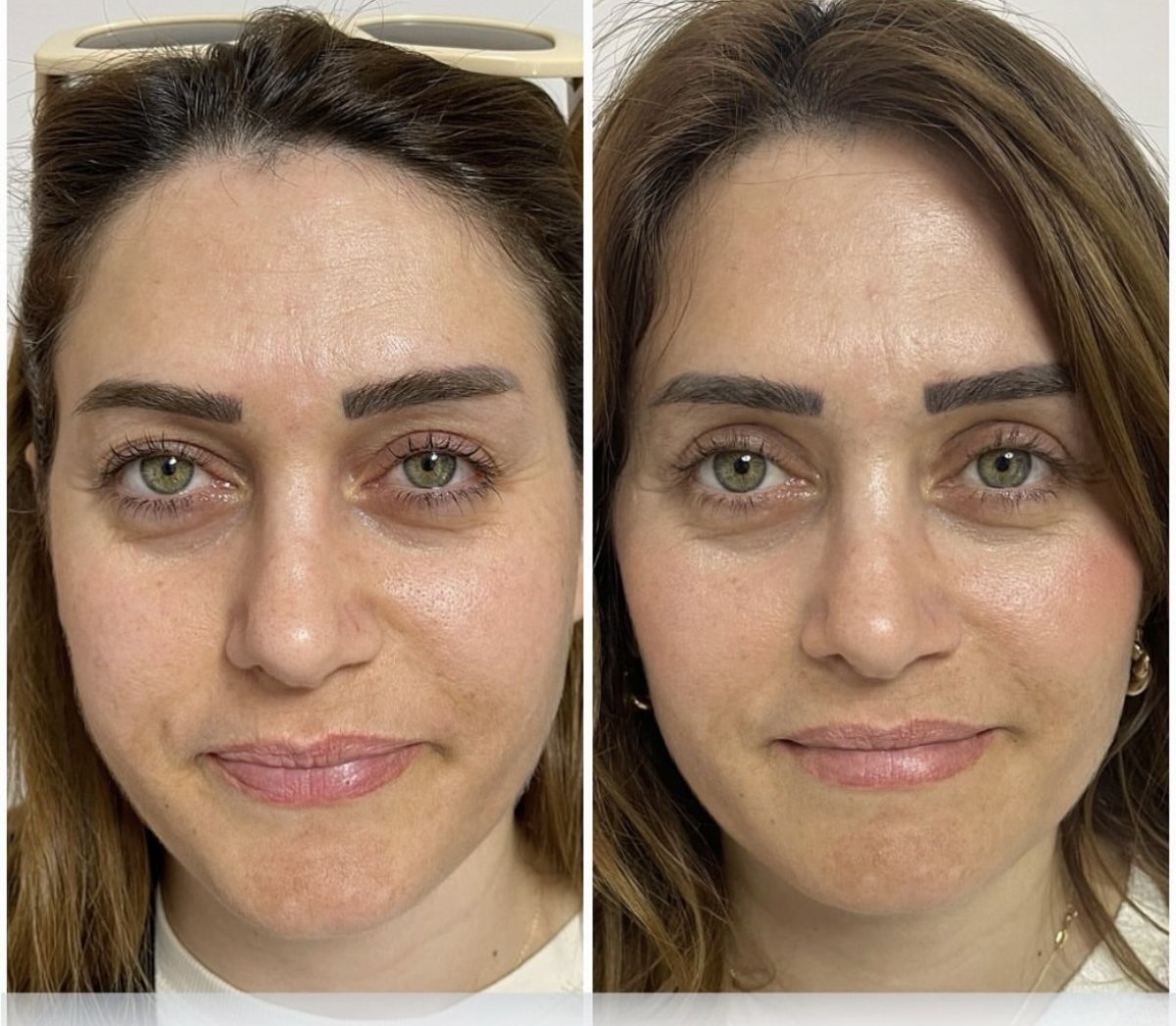 نتائج رأب الجفن قبل وبعد في ÜMRAN TIP MERKEZİ، تصحيح الجفون