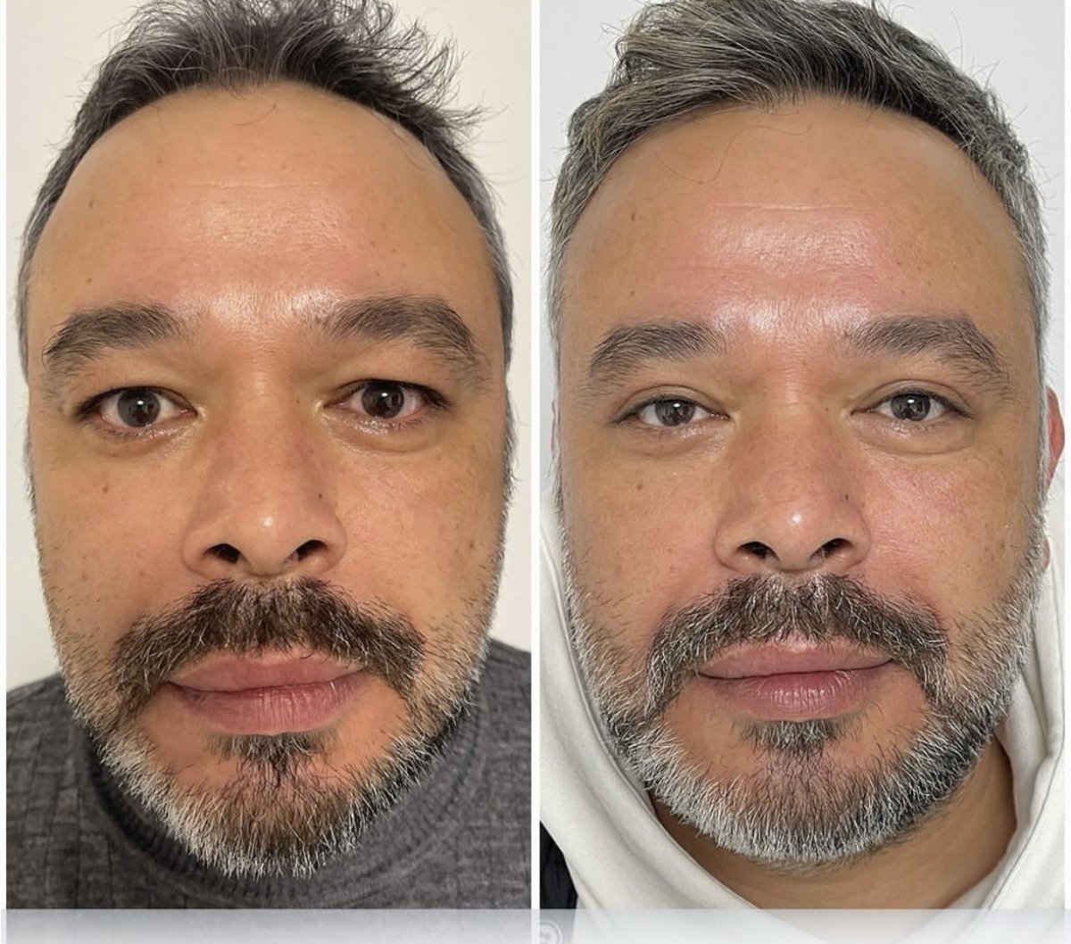 Résultats avant/après blépharoplastie chez ÜMRAN TIP MERKEZİ, correction des paupières homme
