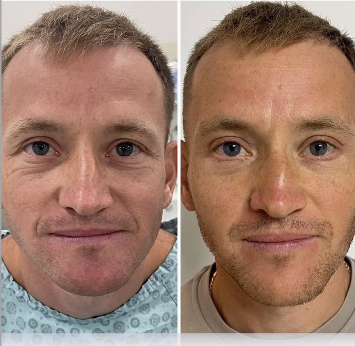 Vorher-nachher-Ergebnis der Blepharoplastik bei ÜMRAN TIP MERKEZİ, Lidkorrektur für Männer