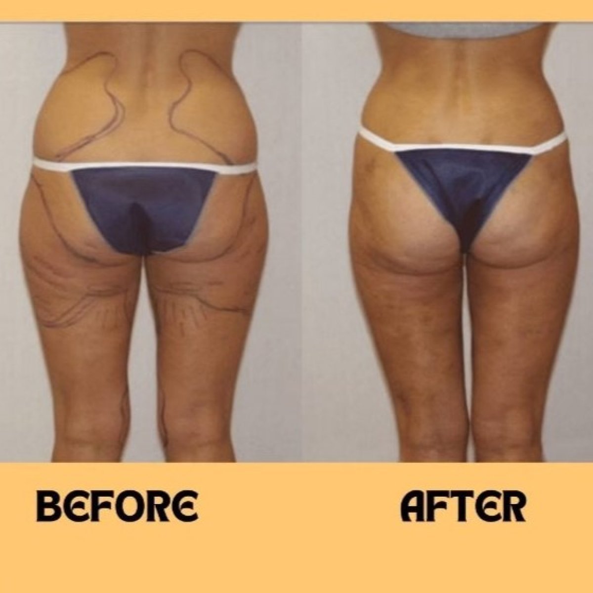 Before and after thigh liposuction results at ID Clinic Bangkok, improved leg contour visible