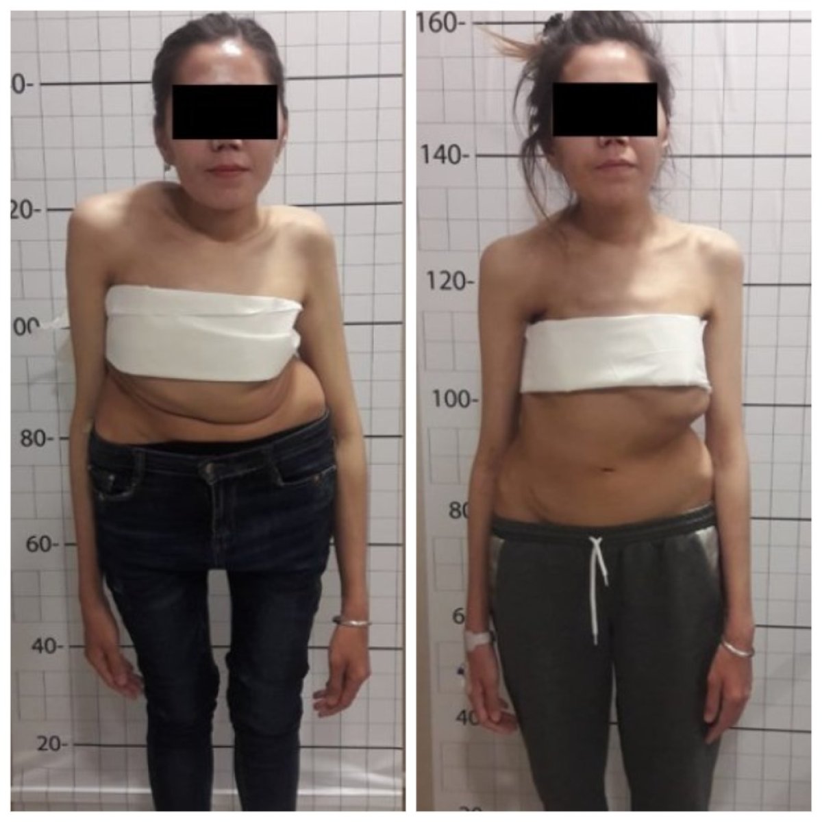 Resultados antes y después de cirugía de escoliosis en NP Istanbul Brain Hospital, mejor postura