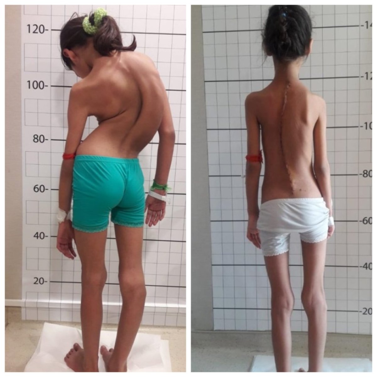 Before and after scoliosis surgery results at NP Istanbul Brain Hospital, improved spine alignment