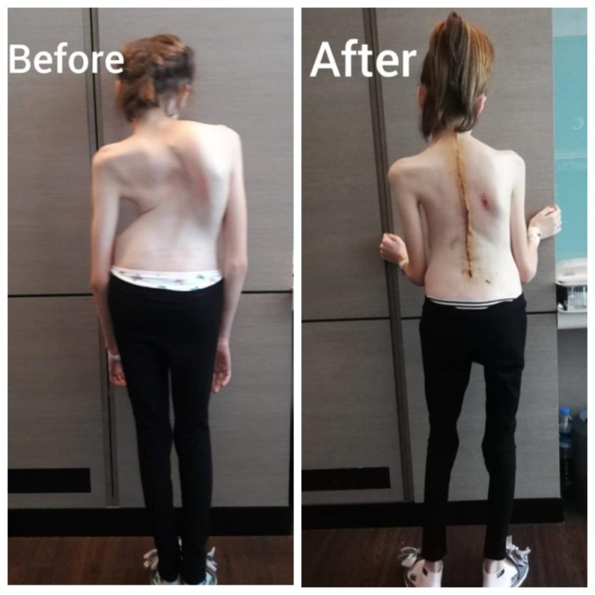 Before and after scoliosis surgery results at NP Istanbul Brain Hospital, improved spine alignment