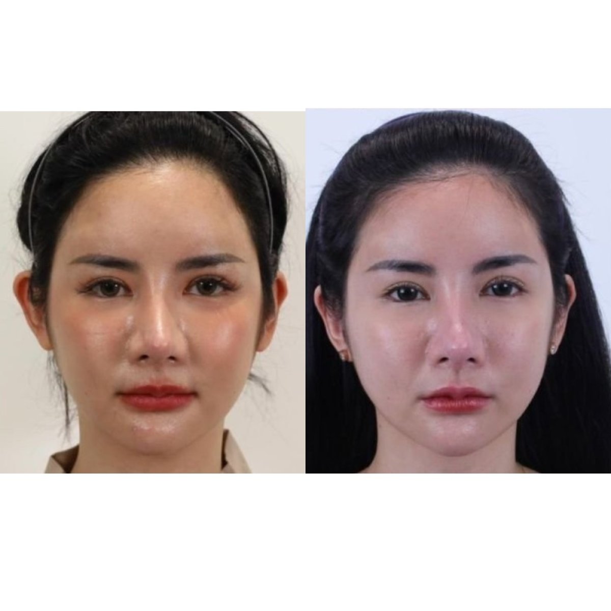نتائج عملية تجميل الأذن قبل وبعد في مستشفى وانسيري، إعادة تشكيل الأذن بمظهر طبيعي