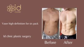 Before and after Вазер (Vaser) липосакция photos by Dr. Dr Phatcharasak Kraisornphongsakul Md