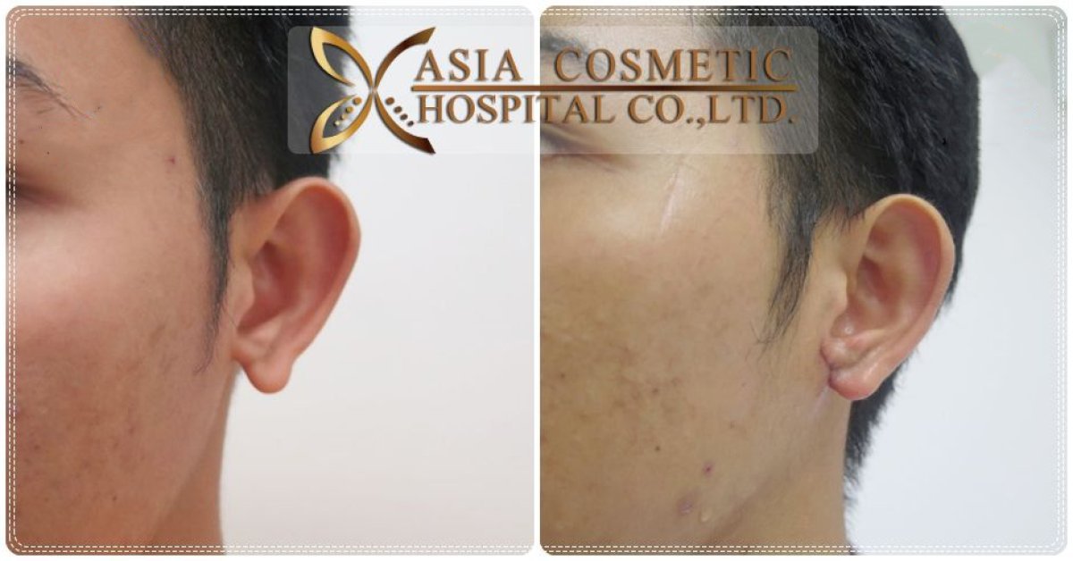 Before and after otoplasty results at Asia Cosmetic Hospital, improved ear shape and position