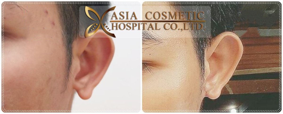 Before and after otoplasty results at Asia Cosmetic Hospital, improved ear shape and contour