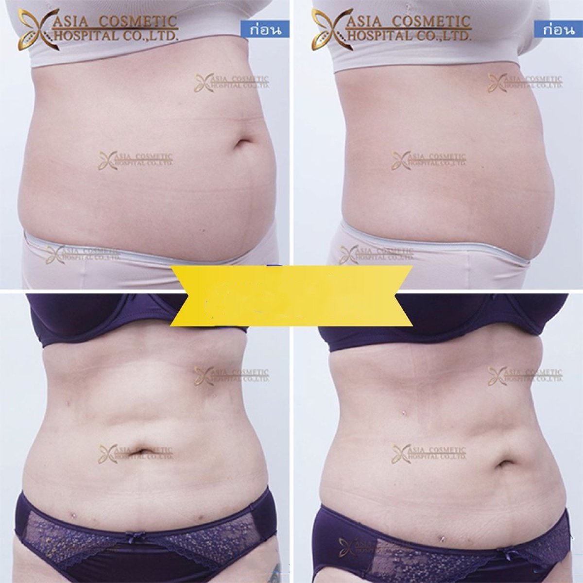 Before and after liposuction results at Asia Cosmetic Hospital, visible abdominal contouring