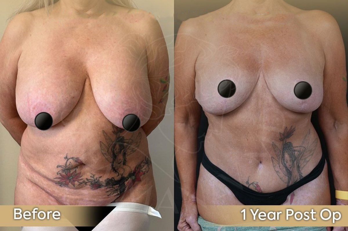 Before and after breast implant removal results at Dr. Safa Manav Clinic, 1 year post-op