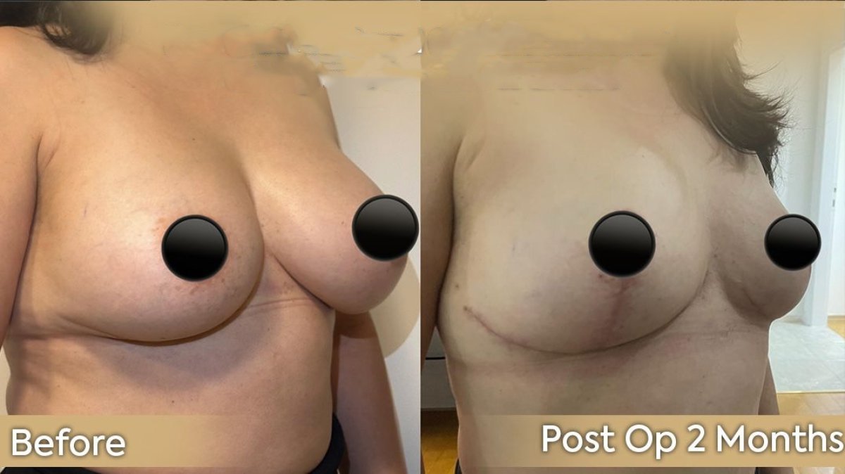 Resultados antes y después de extracción de implantes mamarios en Dr. Safa Manav, 2 meses