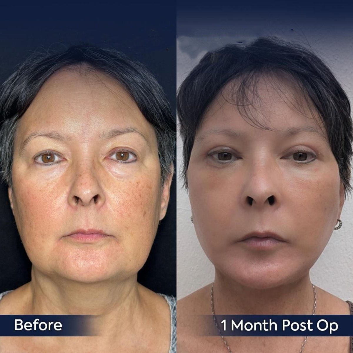 Resultados de blefaroplastia superior antes y después en Dr. Safa Manav Clinic, 1 mes
