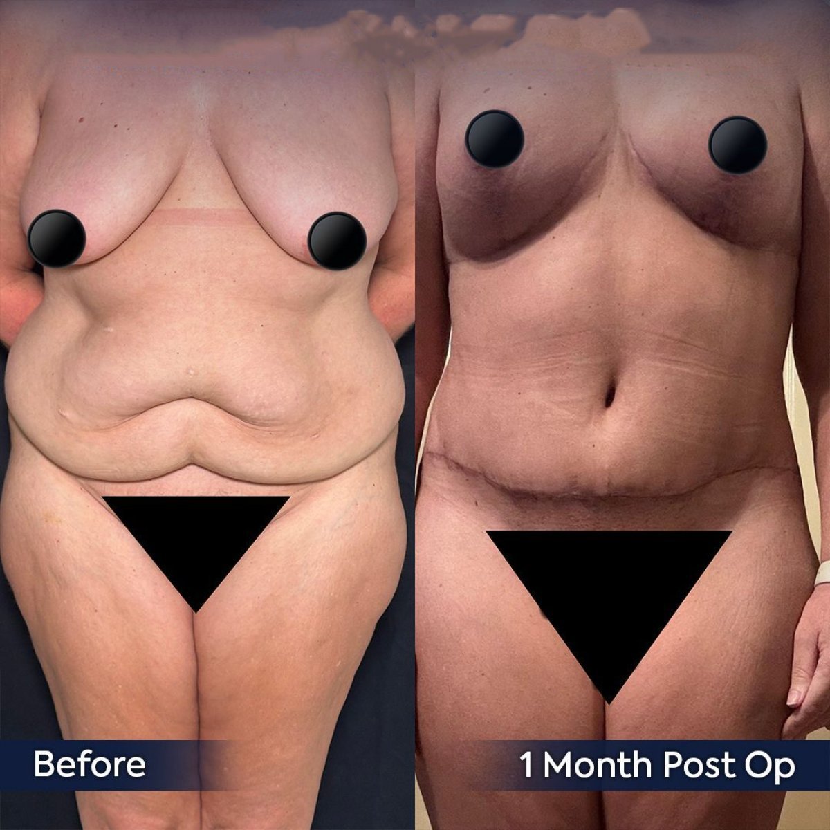 Resultados de abdominoplastia antes y después en Dr. Safa Manav Clinic – abdomen plano en 1 mes