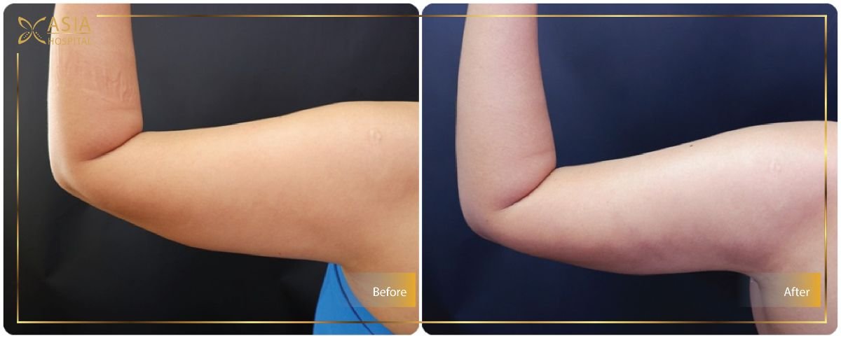 Before and after arm liposuction results at Asia Cosmetic Hospital, improved arm contour