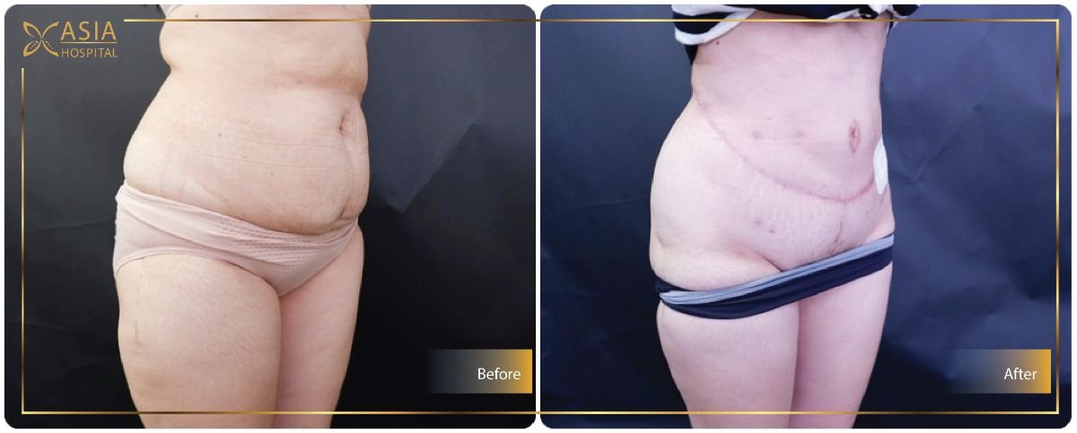Before and after liposuction results at Asia Cosmetic Hospital, visible abdominal contouring