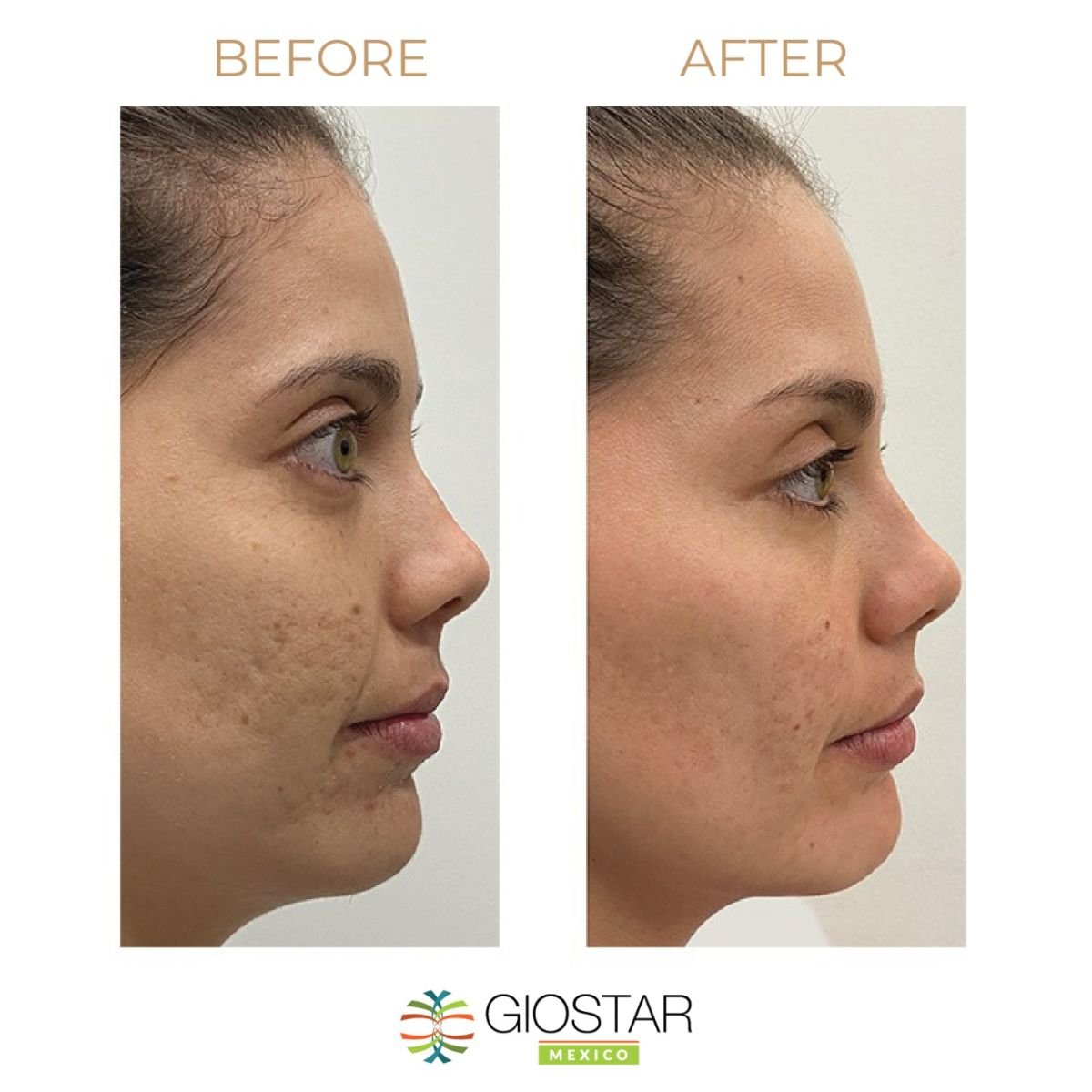Before and after stem cell therapy for facial skin rejuvenation at Giostar Cancun Clinic