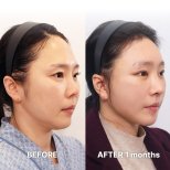 Facelift results by Dr. Yong Woo Kim - Patient’s before and after images Before and after Facelift photos by Dr. Yong Woo Kim