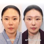 Facelift results by Dr. Yong Woo Kim - Patient’s before and after images Before and after Facelift photos by Dr. Yong Woo Kim