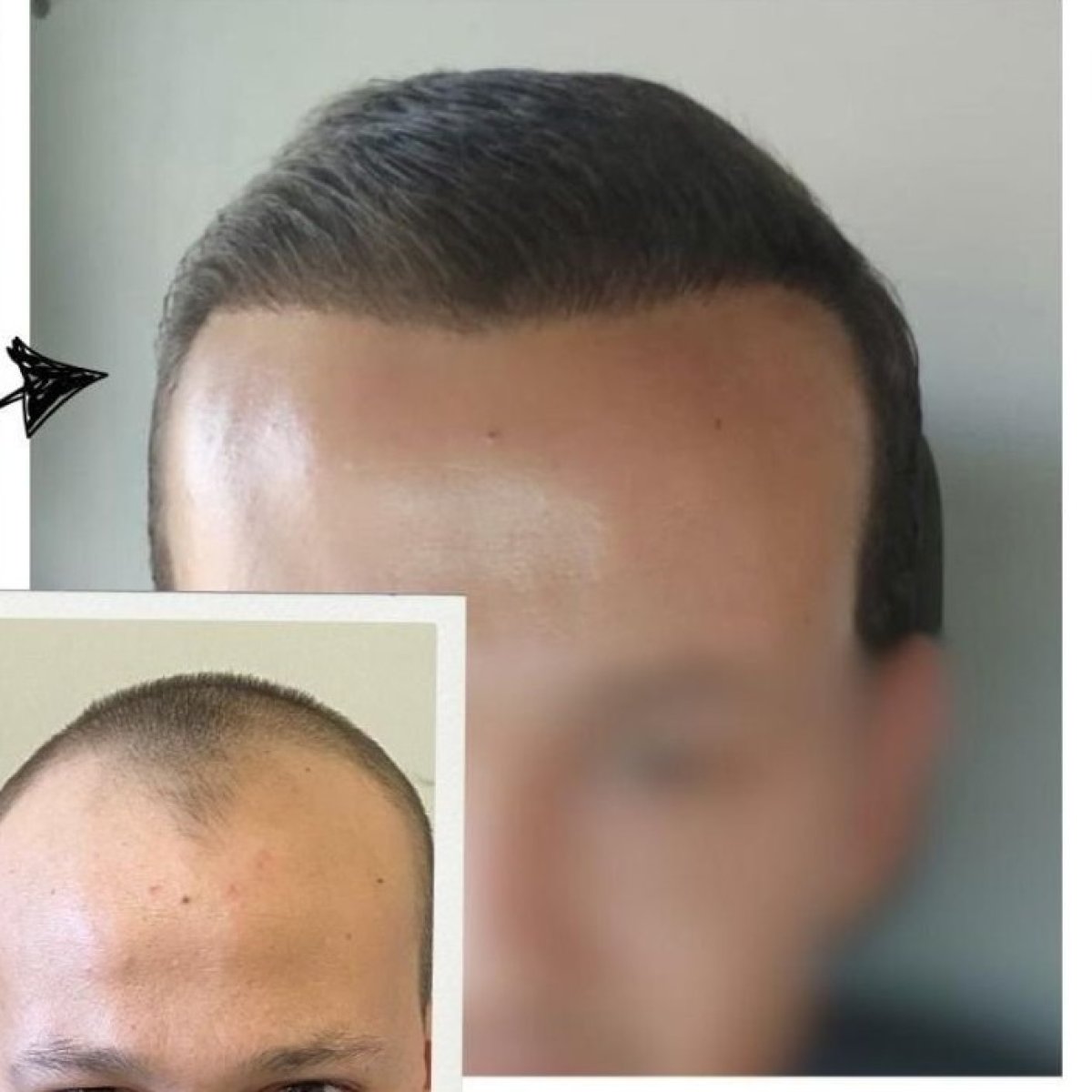 نتائج زراعة الشعر قبل وبعد في مجمع مستشفى ميديكال بارك أنطاليا، خط شعر أكثر كثافة