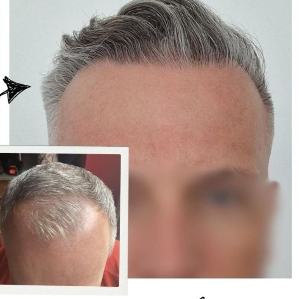 Before and after hair transplant results at Medical Park Antalya Hospital Complex, fuller hairline