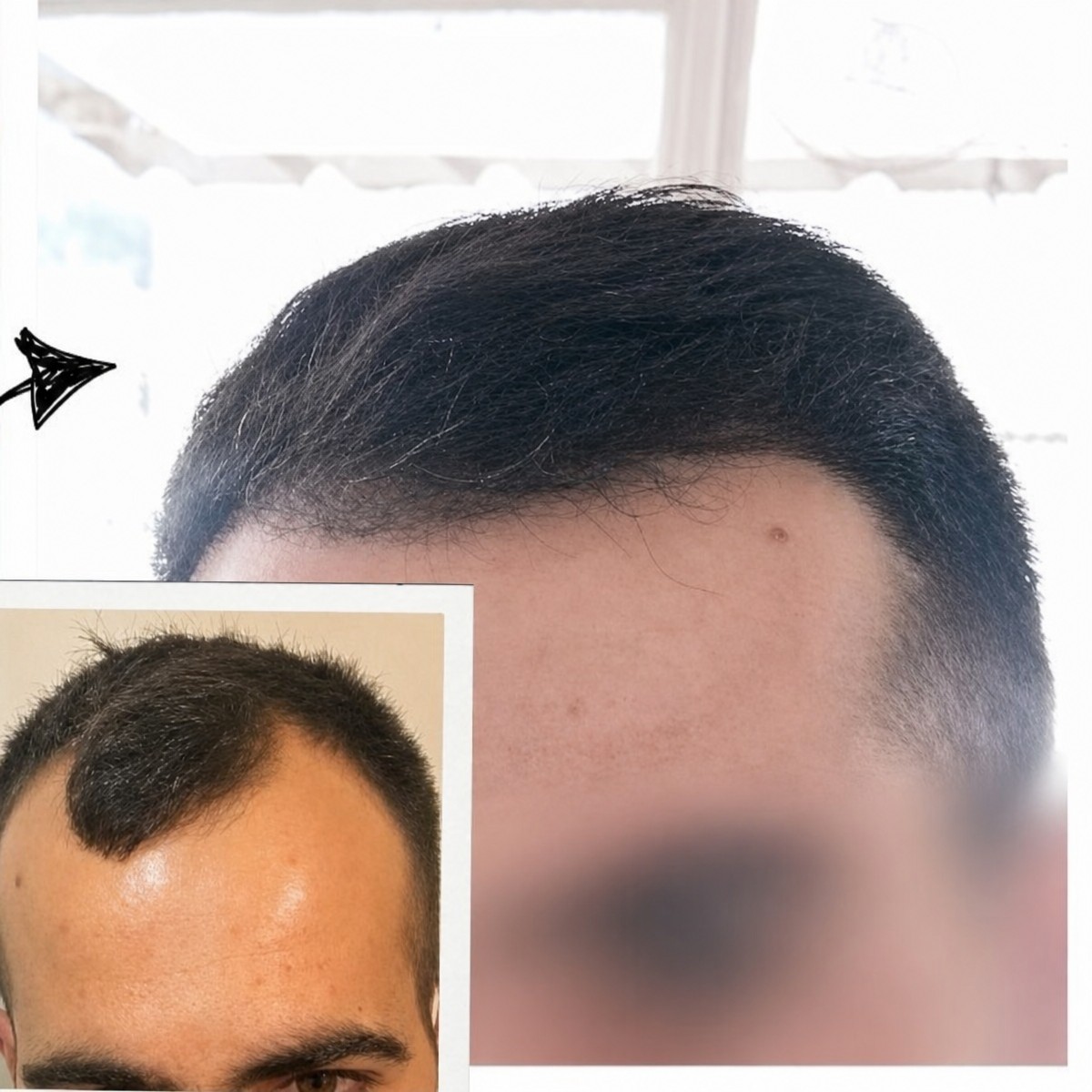 نتائج زراعة الشعر قبل وبعد في مجمع مستشفى ميديكال بارك أنطاليا، خط شعر مستعاد