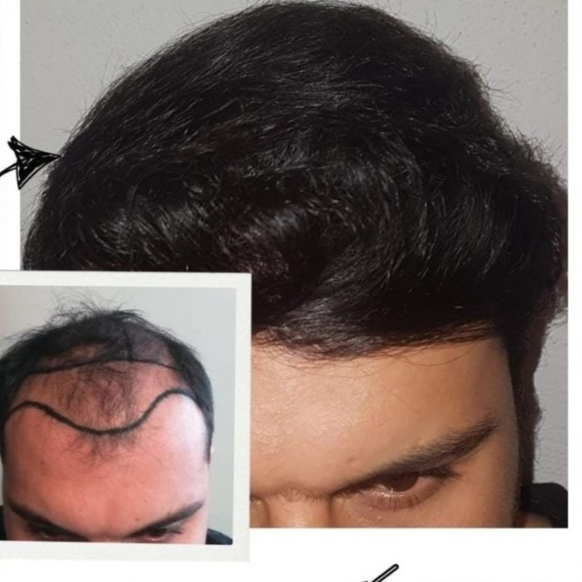 Before and after hair transplant results at Medical Park Antalya Hospital Complex, fuller hairline
