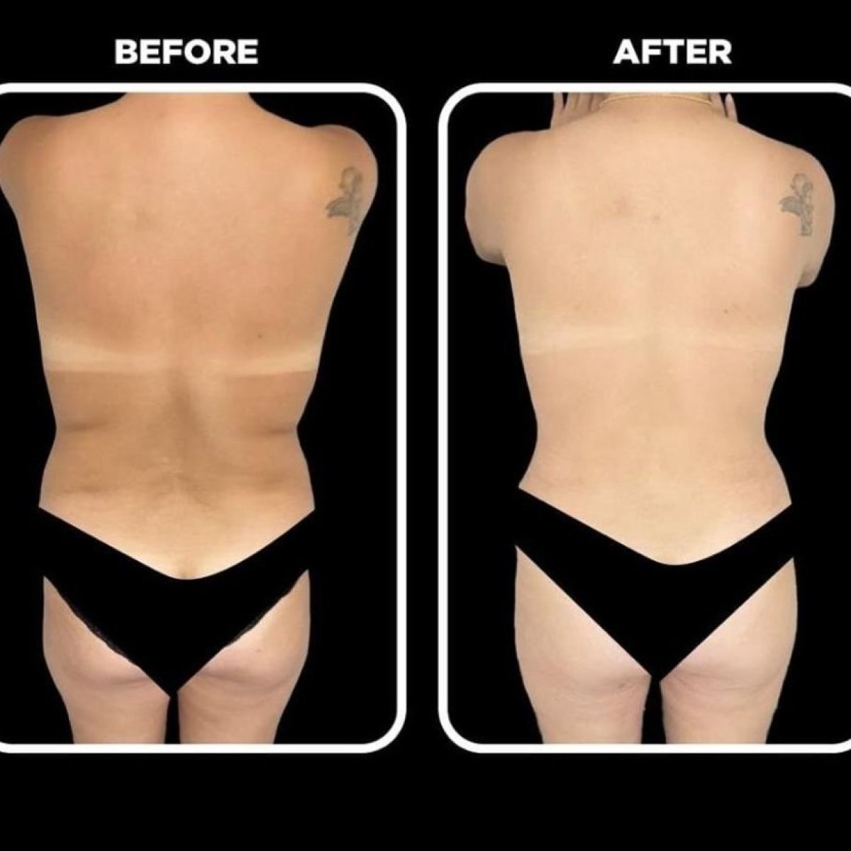 Before and after back liposuction results at Medical Park Antalya Hospital Complex