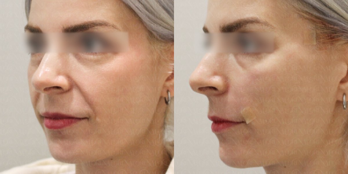 Before and after threads lifting results at Forena Clinic, facial contour improvement visible