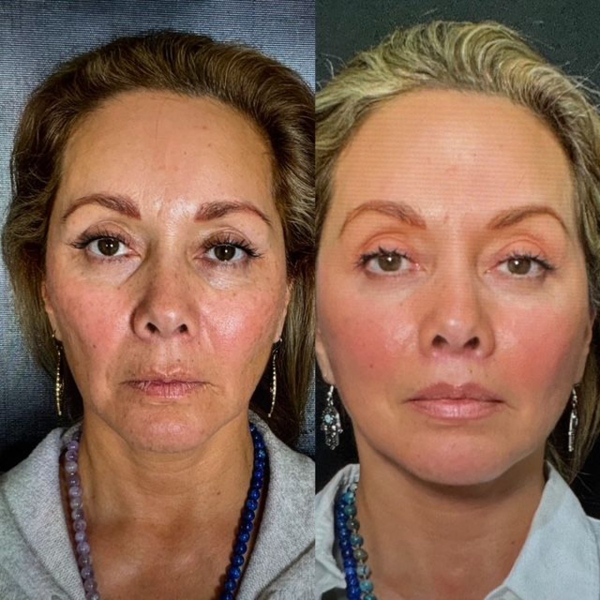 Before and after deep plane facelift results at Marroquín & Sandoval Plastic Surgery Clinic