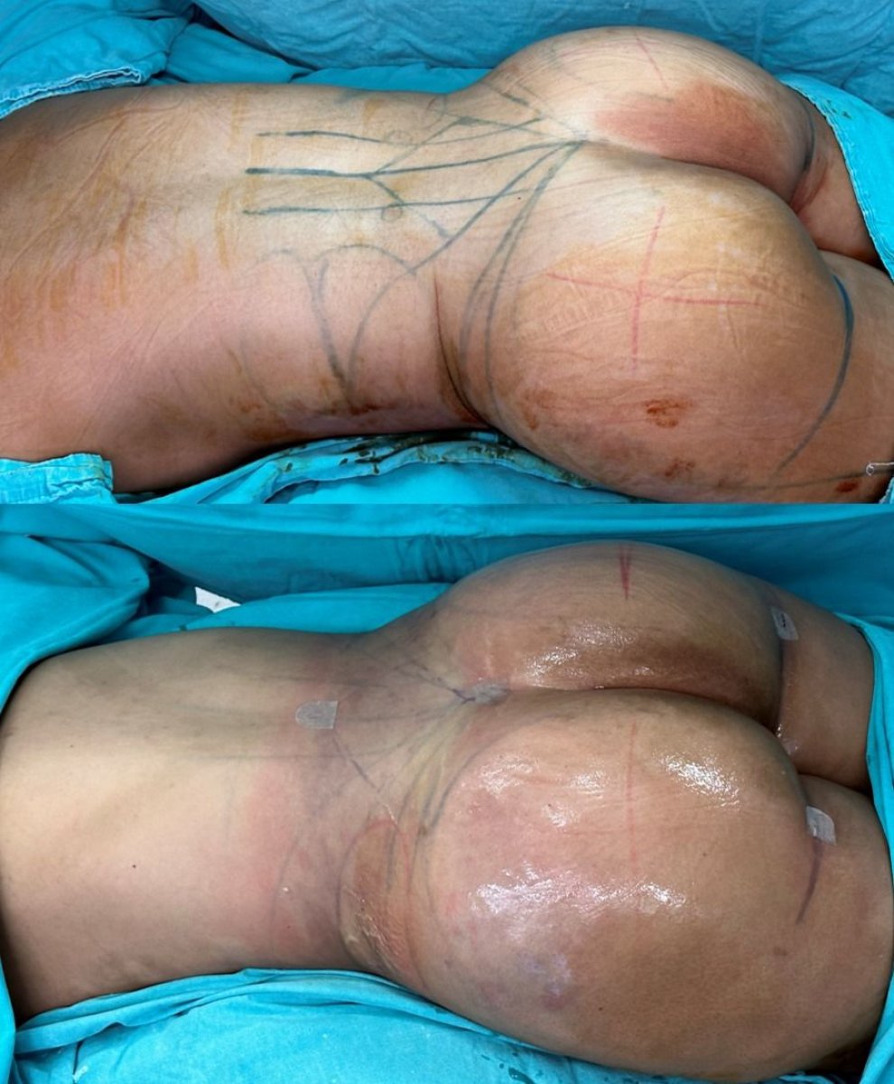 نتائج قبل وبعد عملية شد المؤخرة البرازيلية في عيادة Dr. Safa Manav، تحسين شكل الأرداف